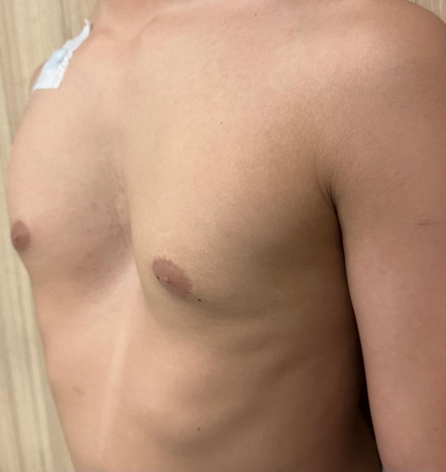 Çocuklarda Göğüs Duvarı Deformiteleri - Pektus